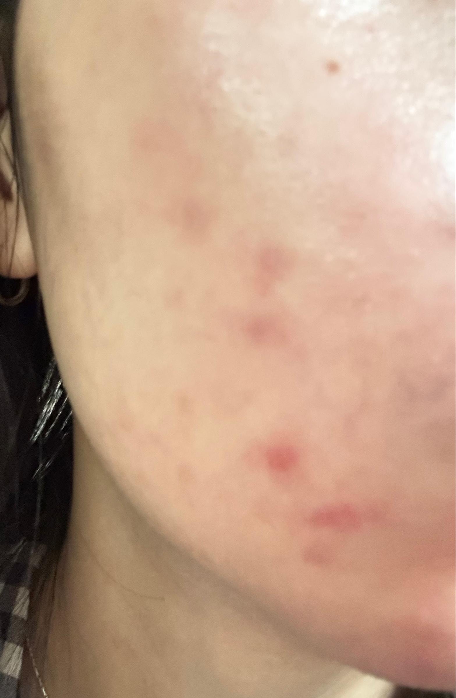 Close-up of a person's neck and ear with visible skin conditions.